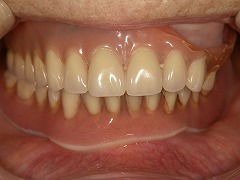 コンフォート義歯の写真