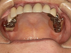 粘膜調整義歯の写真