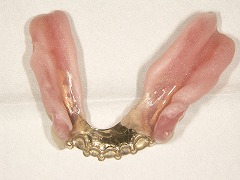 コーヌスクローネ義歯すれ違い咬合の写真
