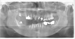 総義歯の写真