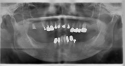 総義歯の写真