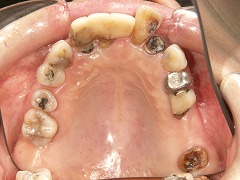 コーヌスクローネ義歯症例の写真