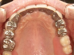 コーヌスクローネ義歯の写真