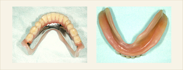 コンフォート総義歯02（5年経過症例）