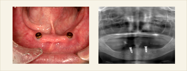 インプラントマグネット義歯01 ■インプラント