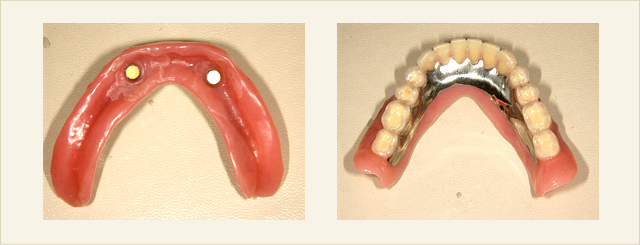 インプラントマグネット義歯01 ■マグネット総義歯