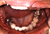 インプラント併用義歯02