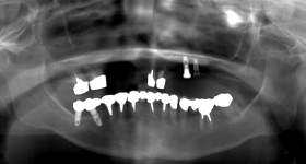 インプラント併用義歯02