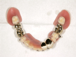 インプラント併用義歯03 ※インプラント併用のコーヌスクローネ義歯