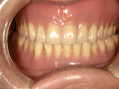 コンフォート総義歯02（5年経過症例）