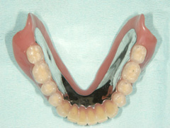 インプラントマグネット義歯02　今回、当院で製作したもの（※チタン床使用）