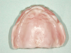 インプラントマグネット義歯02 治療途中の粘膜調整義歯