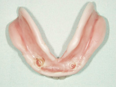 インプラントマグネット義歯02　治療途中の粘膜調整義歯