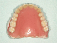 インプラントマグネット義歯02