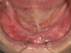 粘膜調整義歯の写真