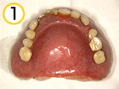 コンフォート総義歯01（装着後6年症例）
