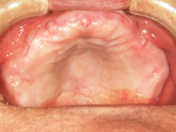 粘膜調整義歯の写真
