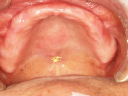 粘膜調整義歯の写真