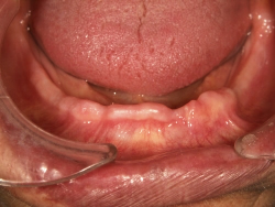 粘膜調整義歯の写真