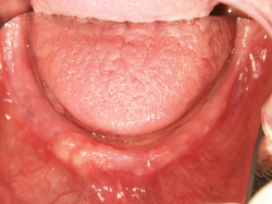 粘膜調整義歯症例の写真