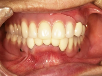 コーヌスクローネ義歯すれ違い咬合症例（装着後3年経過） 