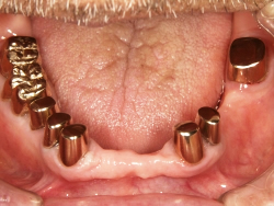 コーヌスクローネ義歯の写真