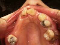 インプラント併用義歯の症例