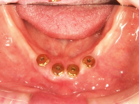 インプラント併用義歯の症例