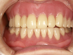 コンフォート義歯の写真